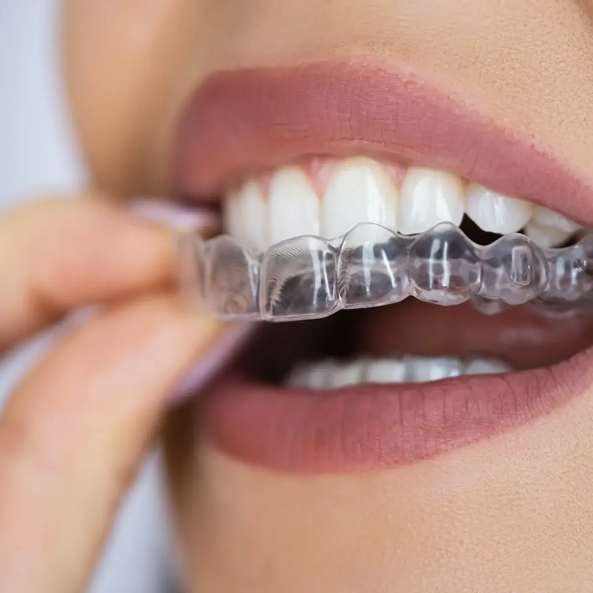 654b17f4a2fcfc932ebf32e7_sorriso-perfeito-invisalign-1200x1200