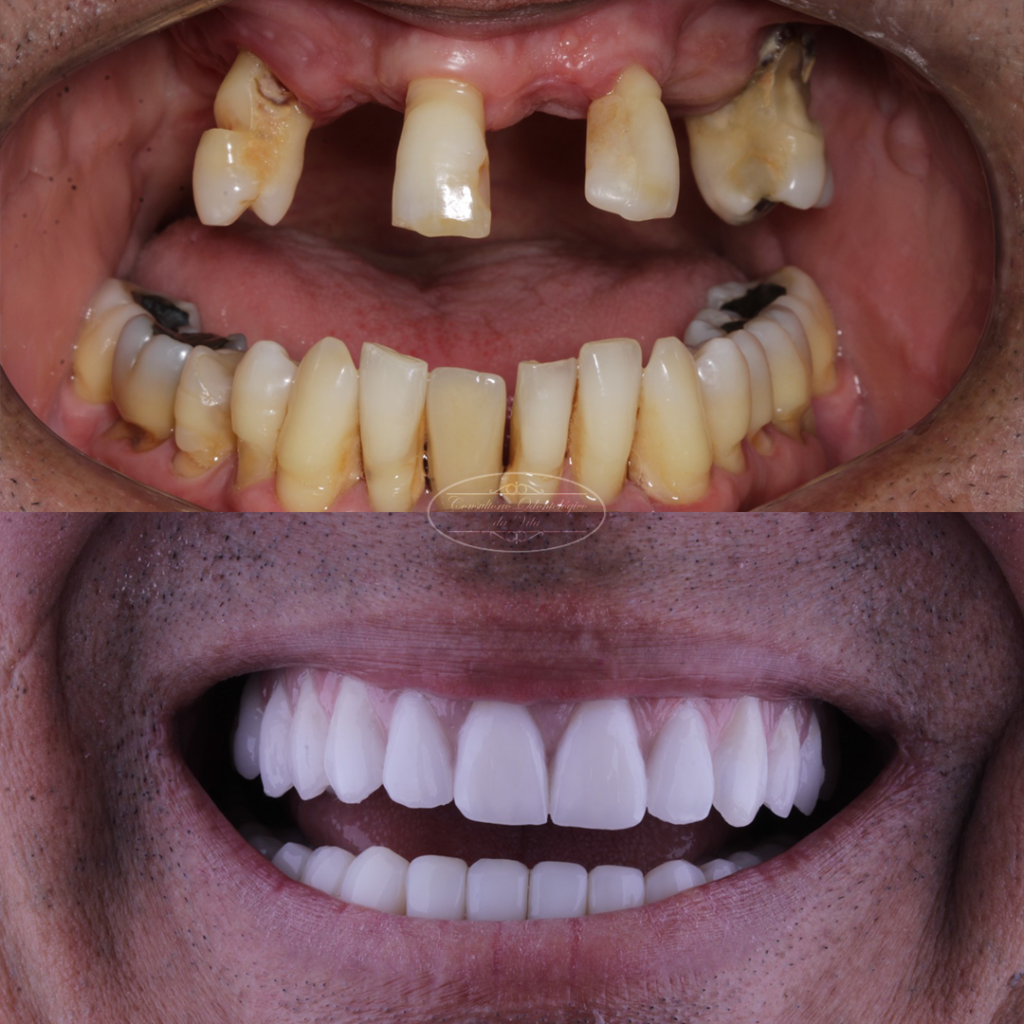 antes e depois