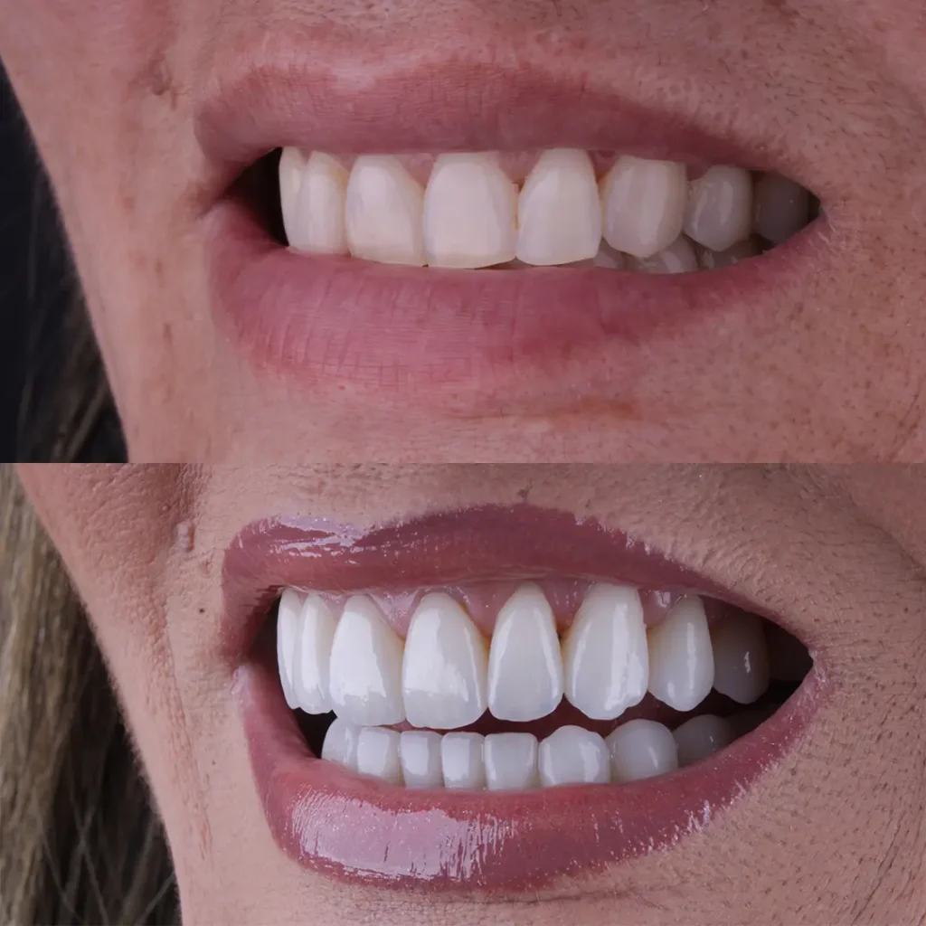Antes e Depois 4
