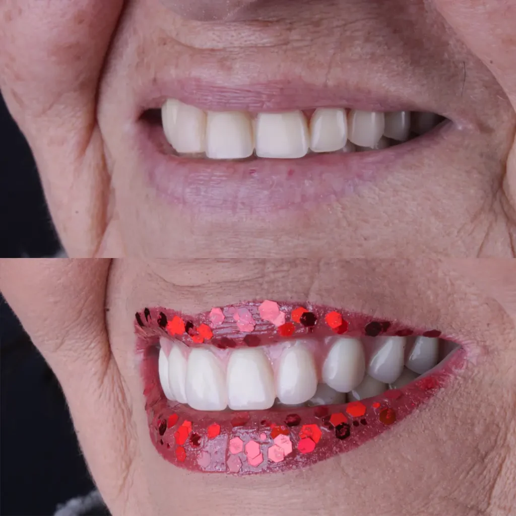 Antes e Depois 5