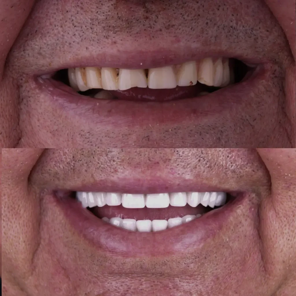 Antes e depois