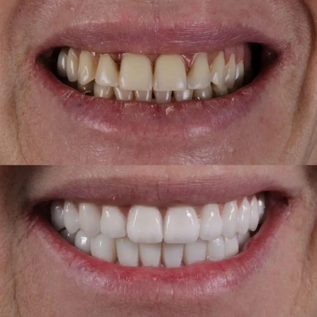Antes e depois 2