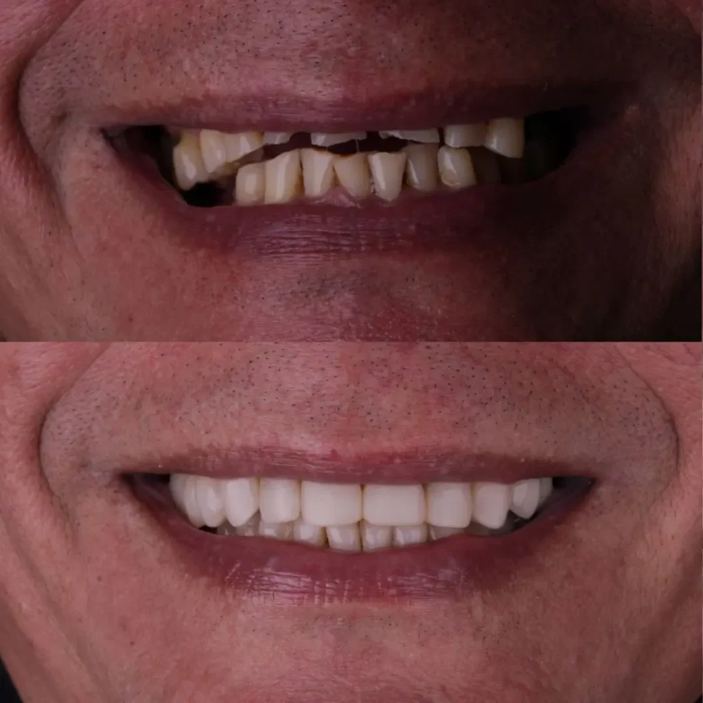 Antes e depois 3